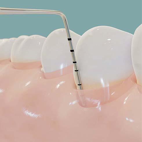 Periodontics in Lower Sackville